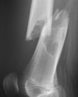 long-bone-tumor-resulting-in-fracture