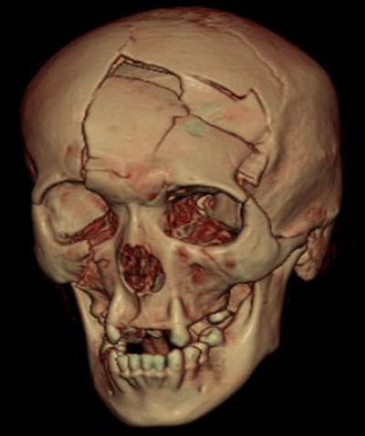 complex-cranial-bone-trauma