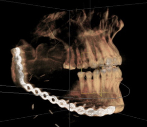 excised-mandible-tumor