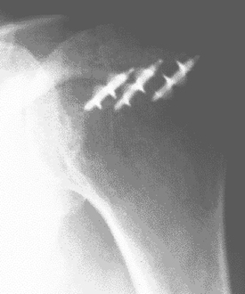 rotator-cuff-re-attachment-to-bone